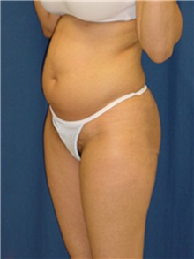 Buttock Implants Before Photo by Ricardo Rodriguez, MD; Lutherville-Timonium, MD - Case 27161