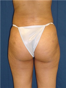 Buttock Implants After Photo by Ricardo Rodriguez, MD; Lutherville-Timonium, MD - Case 27161