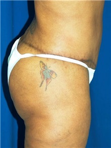 Buttock Implants After Photo by Ricardo Rodriguez, MD; Lutherville-Timonium, MD - Case 27162