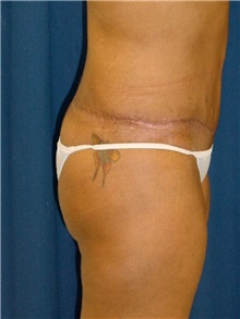 Buttock Implants Before Photo by Ricardo Rodriguez, MD; Lutherville-Timonium, MD - Case 27162