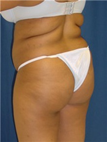 Buttock Implants Before Photo by Ricardo Rodriguez, MD; Lutherville-Timonium, MD - Case 27163