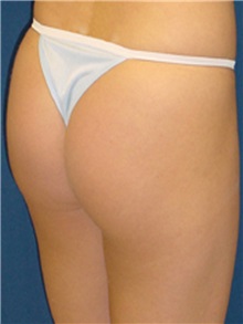 Buttock Implants After Photo by Ricardo Rodriguez, MD; Lutherville-Timonium, MD - Case 27164