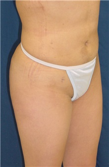 Buttock Implants After Photo by Ricardo Rodriguez, MD; Lutherville-Timonium, MD - Case 27165