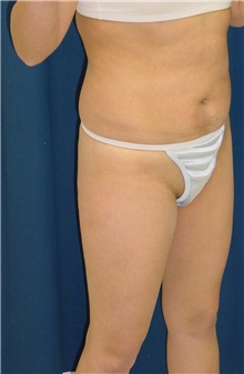 Buttock Implants Before Photo by Ricardo Rodriguez, MD; Lutherville-Timonium, MD - Case 27165
