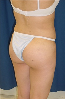 Buttock Implants After Photo by Ricardo Rodriguez, MD; Lutherville-Timonium, MD - Case 27165