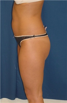 Buttock Implants Before Photo by Ricardo Rodriguez, MD; Lutherville-Timonium, MD - Case 27166