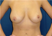Breast Lift After Photo by Ricardo Rodriguez, MD; Lutherville-Timonium, MD - Case 27181