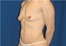 Breast Lift Before Photo by Ricardo Rodriguez, MD; Lutherville-Timonium, MD - Case 27181