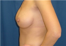 Breast Lift After Photo by Ricardo Rodriguez, MD; Lutherville-Timonium, MD - Case 27181