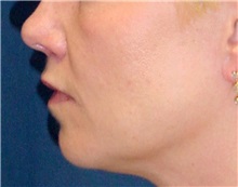Dermal Fillers After Photo by Ricardo Rodriguez, MD; Lutherville-Timonium, MD - Case 27316