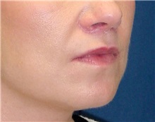 Dermal Fillers After Photo by Ricardo Rodriguez, MD; Lutherville-Timonium, MD - Case 27316