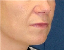 Dermal Fillers Before Photo by Ricardo Rodriguez, MD; Lutherville-Timonium, MD - Case 27316