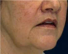 Dermal Fillers After Photo by Ricardo Rodriguez, MD; Lutherville-Timonium, MD - Case 27317