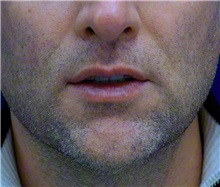 Dermal Fillers After Photo by Ricardo Rodriguez, MD; Lutherville-Timonium, MD - Case 27318