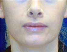 Dermal Fillers After Photo by Ricardo Rodriguez, MD; Lutherville-Timonium, MD - Case 27319