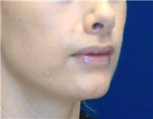 Dermal Fillers After Photo by Ricardo Rodriguez, MD; Lutherville-Timonium, MD - Case 27319