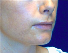Dermal Fillers Before Photo by Ricardo Rodriguez, MD; Lutherville-Timonium, MD - Case 27319