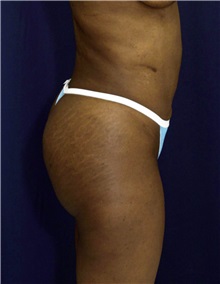 Buttock Implants After Photo by Ricardo Rodriguez, MD; Lutherville-Timonium, MD - Case 27373
