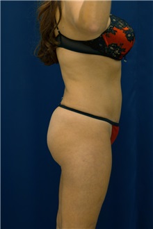Buttock Implants After Photo by Ricardo Rodriguez, MD; Lutherville-Timonium, MD - Case 27375