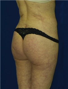 Buttock Implants After Photo by Ricardo Rodriguez, MD; Lutherville-Timonium, MD - Case 27377