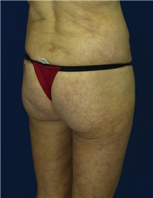 Buttock Implants Before Photo by Ricardo Rodriguez, MD; Lutherville-Timonium, MD - Case 27377