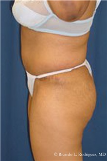 Tummy Tuck After Photo by Ricardo Rodriguez, MD; Lutherville-Timonium, MD - Case 32268