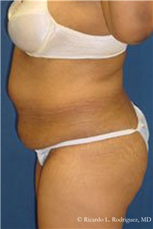 Tummy Tuck Before Photo by Ricardo Rodriguez, MD; Lutherville-Timonium, MD - Case 32268