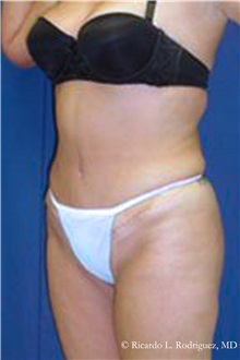 Tummy Tuck After Photo by Ricardo Rodriguez, MD; Lutherville-Timonium, MD - Case 32269