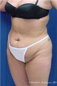 Tummy Tuck Before Photo by Ricardo Rodriguez, MD; Lutherville-Timonium, MD - Case 32269