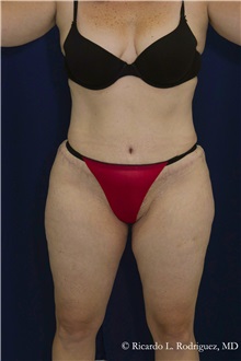 Tummy Tuck After Photo by Ricardo Rodriguez, MD; Lutherville-Timonium, MD - Case 32270
