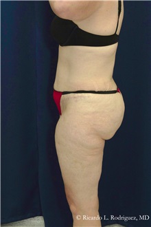 Tummy Tuck After Photo by Ricardo Rodriguez, MD; Lutherville-Timonium, MD - Case 32270