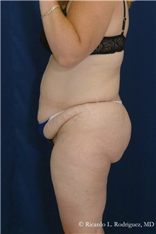 Tummy Tuck Before Photo by Ricardo Rodriguez, MD; Lutherville-Timonium, MD - Case 32270