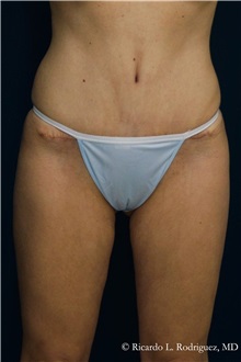 Tummy Tuck After Photo by Ricardo Rodriguez, MD; Lutherville-Timonium, MD - Case 32271