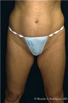 Tummy Tuck Before Photo by Ricardo Rodriguez, MD; Lutherville-Timonium, MD - Case 32271