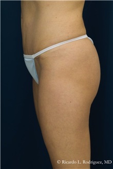 Tummy Tuck After Photo by Ricardo Rodriguez, MD; Lutherville-Timonium, MD - Case 32271