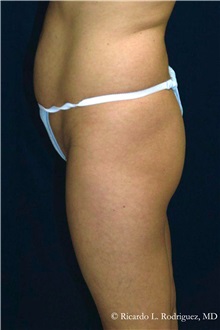 Tummy Tuck Before Photo by Ricardo Rodriguez, MD; Lutherville-Timonium, MD - Case 32271