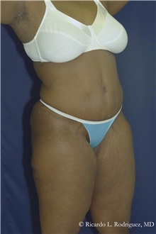 Tummy Tuck After Photo by Ricardo Rodriguez, MD; Lutherville-Timonium, MD - Case 32272