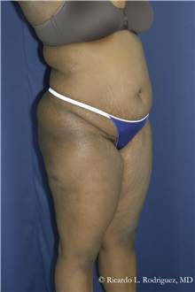 Tummy Tuck Before Photo by Ricardo Rodriguez, MD; Lutherville-Timonium, MD - Case 32272