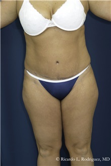 Tummy Tuck After Photo by Ricardo Rodriguez, MD; Lutherville-Timonium, MD - Case 32273