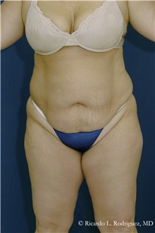 Tummy Tuck Before Photo by Ricardo Rodriguez, MD; Lutherville-Timonium, MD - Case 32273