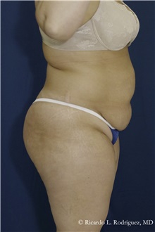 Tummy Tuck Before Photo by Ricardo Rodriguez, MD; Lutherville-Timonium, MD - Case 32273