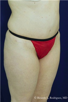Tummy Tuck After Photo by Ricardo Rodriguez, MD; Lutherville-Timonium, MD - Case 32274