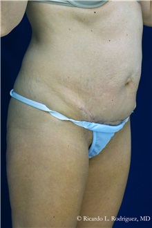 Tummy Tuck Before Photo by Ricardo Rodriguez, MD; Lutherville-Timonium, MD - Case 32274
