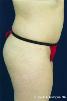 Tummy Tuck After Photo by Ricardo Rodriguez, MD; Lutherville-Timonium, MD - Case 32274