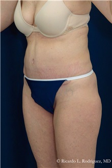 Tummy Tuck After Photo by Ricardo Rodriguez, MD; Lutherville-Timonium, MD - Case 32275