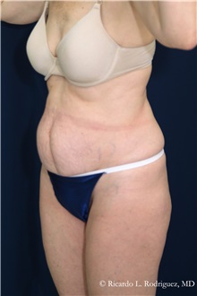 Tummy Tuck Before Photo by Ricardo Rodriguez, MD; Lutherville-Timonium, MD - Case 32275
