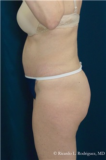 Tummy Tuck After Photo by Ricardo Rodriguez, MD; Lutherville-Timonium, MD - Case 32275