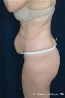 Tummy Tuck Before Photo by Ricardo Rodriguez, MD; Lutherville-Timonium, MD - Case 32275