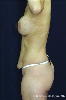 Tummy Tuck Before Photo by Ricardo Rodriguez, MD; Lutherville-Timonium, MD - Case 32276