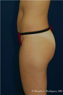 Tummy Tuck After Photo by Ricardo Rodriguez, MD; Lutherville-Timonium, MD - Case 32277